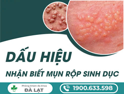 Mụn rộp sinh dục: Nguyên nhân và phương pháp điều trị